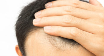 Hair Loss Treatment in India – Detailed Explanation