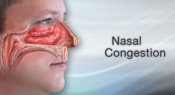 What is nasal congestion – Symptoms