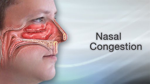 nasal congestion