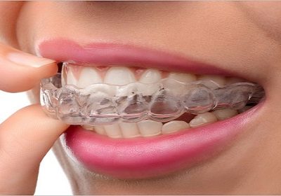 Mouth Guard Day 2020: Types of mouthguards with pros and cons - Time Bulletin Mouth Guard Day 2020: Types of mouthguards with pros and cons - Time Bulletin