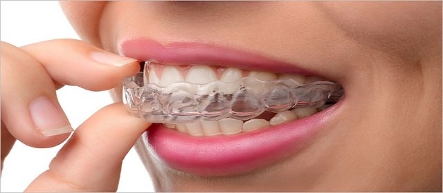 Mouthguards otherwise called gumshields