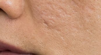 Celebrity Doctor Shares Tips On How To Eliminate Acne Scars