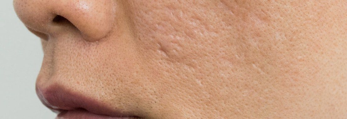 Celebrity Doctor Shares Tips On How To Eliminate Acne Scars