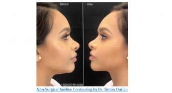 Dr. Simon Ourian Offers “Jawsome”: Non-Surgical Jawline Contouring