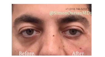 Advanced Cosmetic Procedures For Treating Dark Circles