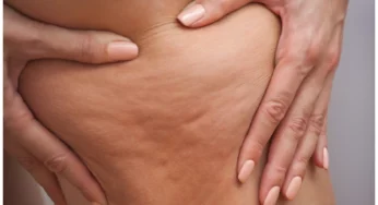 Simon Says: A Guide to Dr. Simon Ourian’s Cellulite Treatment & Removal Process