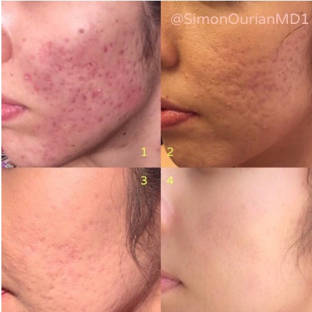 Coolaser Acne and Acne Scars Treatment from @SimonOurianMD1