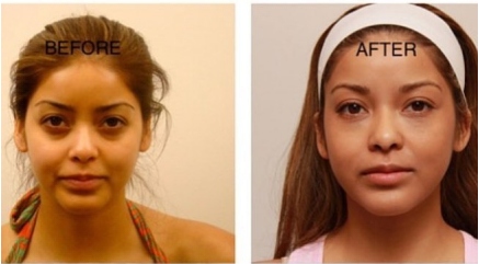 Non Surgical Under Eye Dark Circles Treatment from www.epionebh.com