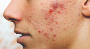 Pimples: Causes Of Acne, How to Take Care of It, Acne Treatment