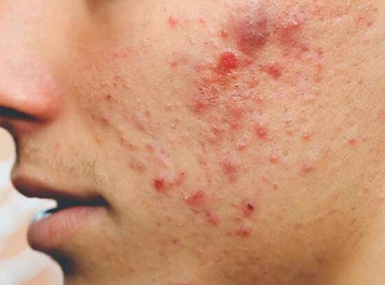 Causes Of Pimples