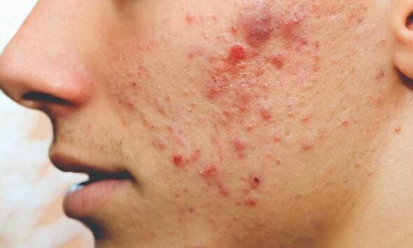 Causes Of Pimples