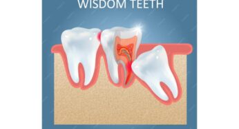 Know About Wisdom Tooth from Langley Dentist