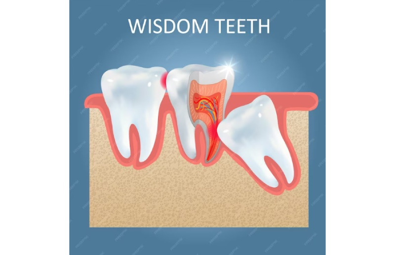 Know About Wisdom Tooth from Langley Dentist