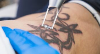 The Impact of Tattoo Regret: Why People Seek Removal in Chicago