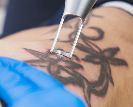 The Impact of Tattoo Regret Why People Seek Removal in Chicago