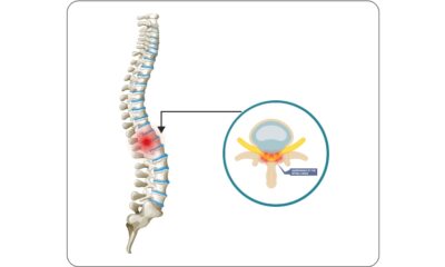 5 Physical Therapy Exercises For Lumbar Spinal Stenosis Relief