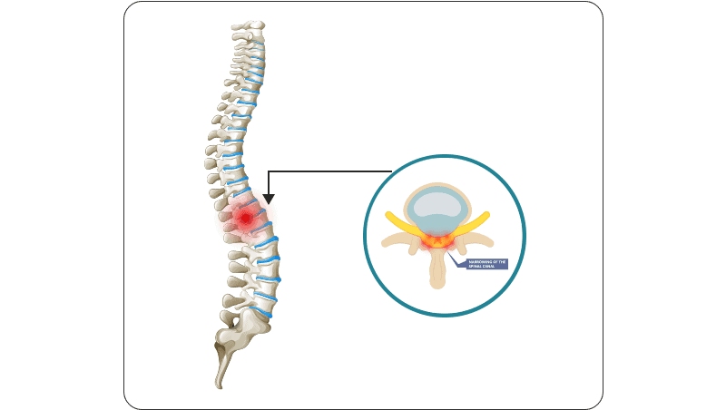5 Physical Therapy Exercises For Lumbar Spinal Stenosis Relief
