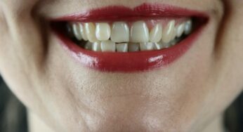 Teeth Whitening: Importance and the Best Place to Go