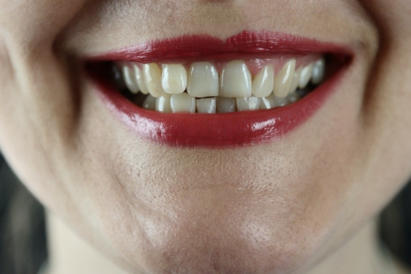 Teeth Whitening Importance and the Best Place to Go