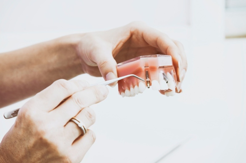 Dental Implants Kelowna Advantages, Procedure, and Post Procedure Care